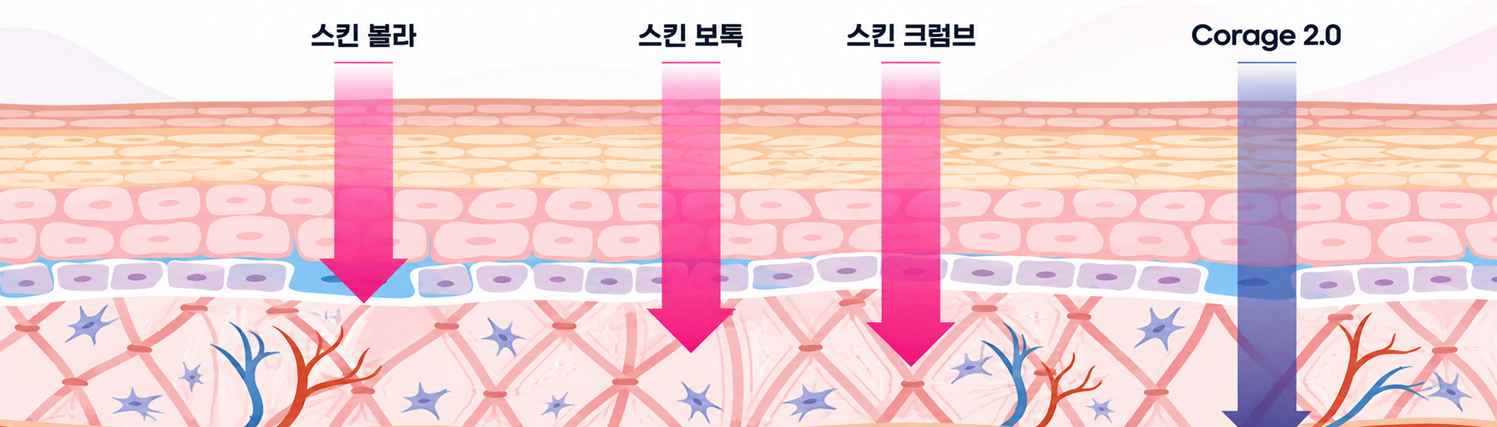 시술 원리 다이어그램